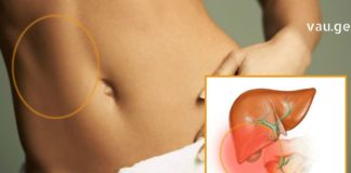 როდის ვითარდება ქოლეცისტიტი და რითი შეგვიძლია გამკლავება – მნიშვნელოვანი ინფორმაცია