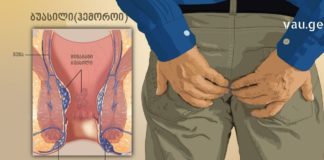 მეთოდი რომელიც აუცილებლად უნდა იცოდეთ თუ თქვენ ბუასილი გაწუხებთ