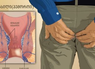 მეთოდი რომელიც აუცილებლად უნდა იცოდეთ თუ თქვენ ბუასილი გაწუხებთ