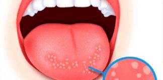 თუ სტომატიტი გაქვთ, სამყურას ნაყენი გიშველით უმოკლეს დროში