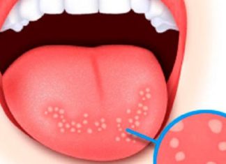 თუ სტომატიტი გაქვთ, სამყურას ნაყენი გიშველით უმოკლეს დროში