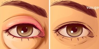 თუ ხშირად გიშუპდებათ თვალები და ქუთუთოები, გასწავლით ყველაზე ეფექტურ მეთოდებს