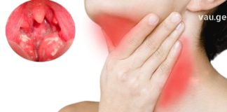 მეთოდი, რომელიც აუცილებად უნდა სცადოთ თუ ანგინა გაქვთ