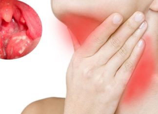 მეთოდი, რომელიც აუცილებად უნდა სცადოთ თუ ანგინა გაქვთ