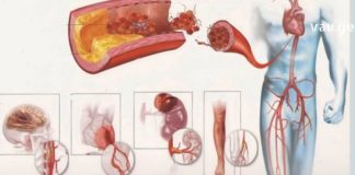 დალიეთ ეს ნაყენი რათა ათეროსკლეროზმა ვერაფერი დაგაკლოთ