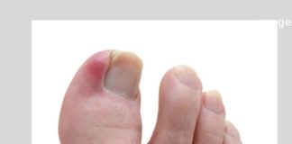 ჩაზრდილი ფრჩხილის მკურნალობა სახლშიც შესალებელია საკმაოდ მარტივად, მტკივნეული პროცედურების გარეშე