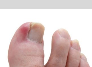 ჩაზრდილი ფრჩხილის მკურნალობა სახლშიც შესალებელია საკმაოდ მარტივად, მტკივნეული პროცედურების გარეშე