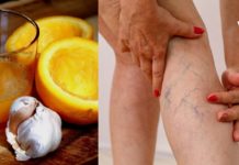 Მარტივი, ნატურალური რეცეპტი დაგეხმარებათ ვარიკოზული ვენების მოცილებაში