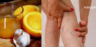 Მარტივი, ნატურალური რეცეპტი დაგეხმარებათ ვარიკოზული ვენების მოცილებაში