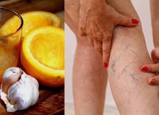 Მარტივი, ნატურალური რეცეპტი დაგეხმარებათ ვარიკოზული ვენების მოცილებაში