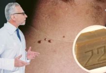 Როგორ უნდა მოვიშოროთ პაპილომები სახლის პირობებში სარეცხი საპნით?!