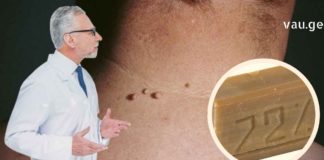 Როგორ უნდა მოვიშოროთ პაპილომები სახლის პირობებში სარეცხი საპნით?!