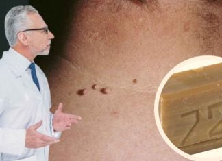 Როგორ უნდა მოვიშოროთ პაპილომები სახლის პირობებში სარეცხი საპნით?!