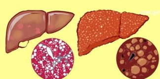 Რამდენად ადვილია ღვიძლის გაწმენდა მედიკამენტების გარეშე? ხალხრი მედიცინა თქვენს სამსახურში!