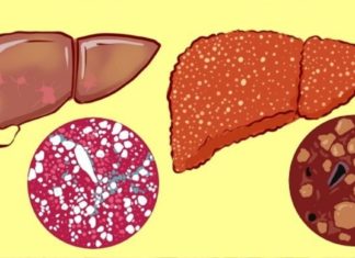 Რამდენად ადვილია ღვიძლის გაწმენდა მედიკამენტების გარეშე? ხალხრი მედიცინა თქვენს სამსახურში!