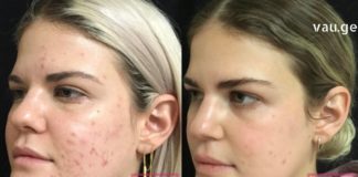 Ეს მწვანე პასტა დაგეხმარებათ გათავისუფლდეთ აკნეს ნაწიბურებისგან მხოლოდ 3 დღეში!