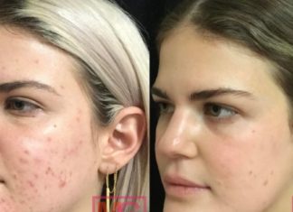 Ეს მწვანე პასტა დაგეხმარებათ გათავისუფლდეთ აკნეს ნაწიბურებისგან მხოლოდ 3 დღეში!