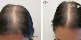 სწრაფი და ბუნებრივი გზა თმის გასაზრდელად მხოლოდ 7 დღეში