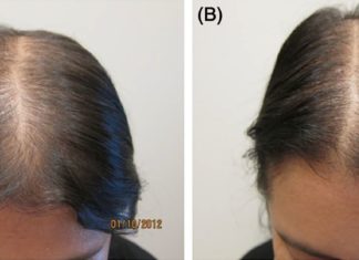 სწრაფი და ბუნებრივი გზა თმის გასაზრდელად მხოლოდ 7 დღეში