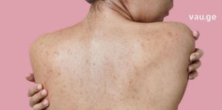 აკნეს საუკეთესო სამკურნალო საშუალება: გაინტერსებთ როგორ მოვიშოროთ აკნე ზურგზე ? გაგიზიარებთ საიდუმლო მეთოდს.