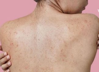 აკნეს საუკეთესო სამკურნალო საშუალება: გაინტერსებთ როგორ მოვიშოროთ აკნე ზურგზე ? გაგიზიარებთ საიდუმლო მეთოდს.