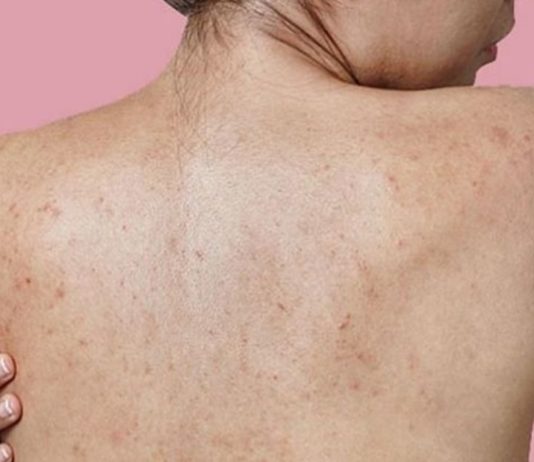 აკნეს საუკეთესო სამკურნალო საშუალება: გაინტერსებთ როგორ მოვიშოროთ აკნე ზურგზე ? გაგიზიარებთ საიდუმლო მეთოდს.