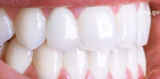 თუ გსურთ გქონდეთ ქათქათა კბილები, მაშინ აუცილებლად უნდა გაითვალისწინოთ ეს რჩევები