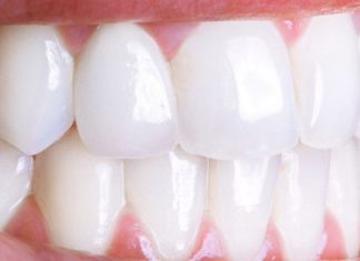 თუ გსურთ გქონდეთ ქათქათა კბილები, მაშინ აუცილებლად უნდა გაითვალისწინოთ ეს რჩევები