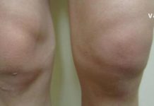 Ხალხური საშუალებები მუხლის ტკივილის შესამსუბუქებლად : სარეცხი საპონის და კომბოსტოს კომპრესები მე ყოველთვის მეხმარება!