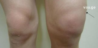 Ხალხური საშუალებები მუხლის ტკივილის შესამსუბუქებლად : სარეცხი საპონის და კომბოსტოს კომპრესები მე ყოველთვის მეხმარება!