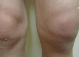 Ხალხური საშუალებები მუხლის ტკივილის შესამსუბუქებლად : სარეცხი საპონის და კომბოსტოს კომპრესები მე  ყოველთვის მეხმარება!