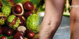 ვარიკოზის მკურნალობა ამ რეცეპტებით ყველზე მარტივად არის შესაძლებელი უმოკლეს დროში