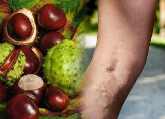 ვარიკოზის მკურნალობა ამ რეცეპტებით ყველზე მარტივად არის შესაძლებელი უმოკლეს დროში