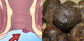 მტანჯველი ბუასილის მკურნალობა ყველაზე სწრაფად და იაფად