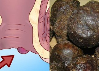 მტანჯველი ბუასილის მკურნალობა ყველაზე სწრაფად და იაფად