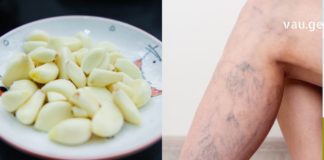 თუ თქვენ ვარიკოზმა შემოგიტიათ აუცილებლად მიმართეთ ამ ხერხს