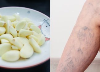 თუ თქვენ ვარიკოზმა შემოგიტიათ აუცილებლად მიმართეთ ამ ხერხს