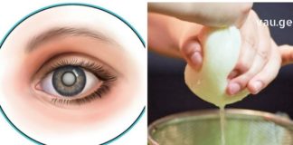 კატარაქტას მკურნალობა არც თუ ისე რთულია როგორც თქვენ წარმოგიდგენიათ – მცენარეული რეცეპტებით უმოკლეს დროში გადაჭრით ამ პრობლემას.