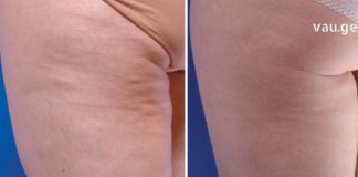 მინდა გასწავლოთ, როგორ უნდა ებრძოლოთ ცელულიტს ხალხური მეთოდით.