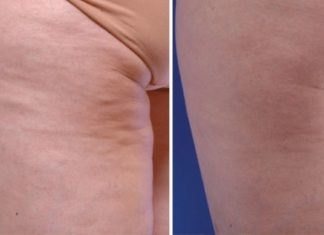 მინდა გასწავლოთ, როგორ უნდა ებრძოლოთ ცელულიტს ხალხური მეთოდით.