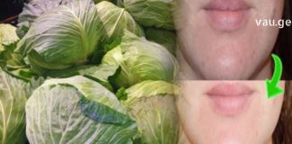 თუ თქვენ გამონაყარი გაქვთ და არ იცით როგორ მოიცილოთ, მოიშველეთ კომბოსტო, იგი საოცრებებს ახდენს