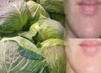 თუ თქვენ გამონაყარი გაქვთ და არ იცით როგორ მოიცილოთ, მოიშველეთ კომბოსტო, იგი საოცრებებს ახდენს