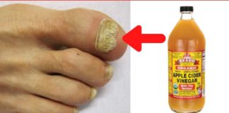 წარმოგიდგენთ 5 გზას, რათა თავიდან აიცილოთ სოკოვანი ინფექცია ერთხელ და სამუდამოდ! – 100%-იანი შედეგი!