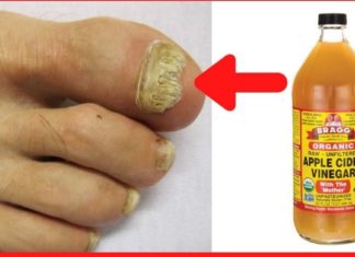 წარმოგიდგენთ 5 გზას, რათა თავიდან აიცილოთ სოკოვანი ინფექცია ერთხელ და სამუდამოდ! – 100%-იანი შედეგი!