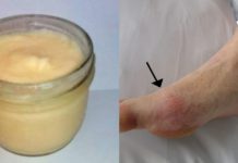 პოდაგრას ტკივილი ძველებური წამლით დავამარცხე