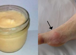 პოდაგრას ტკივილი ძველებური წამლით დავამარცხე