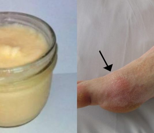 პოდაგრას ტკივილი ძველებური წამლით დავამარცხე