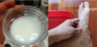 კოჟიჟის მკურნალობის ჩემეული მეთოდი მაქვს, რომელიც, მინდა თქვენც გაგიზიაროთ – პირველივე ცდაზე გაამართლა !