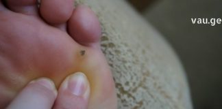 ვეღარ უმკლავდებით კოჟრებთან დაკავშირებულ სირთულეებს? მაშინ ეს სტატია თქვენთვისაა !