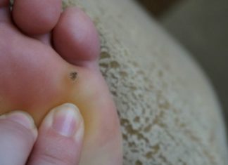 ვეღარ უმკლავდებით კოჟრებთან დაკავშირებულ სირთულეებს? მაშინ ეს სტატია თქვენთვისაა !